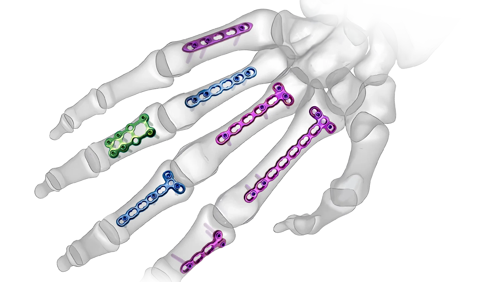 Mini Fragment and Hand locking plate system