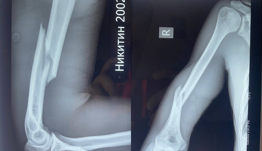 Preoperative right humeral shaft fracture X-ray