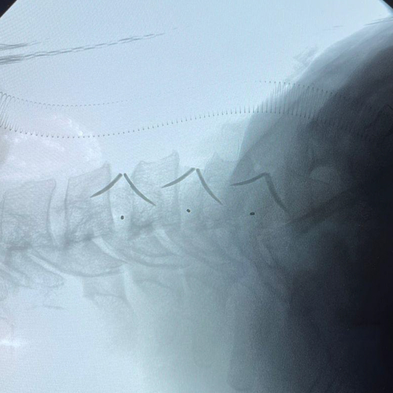 Postoperacia laterala cervika spino-radiografio
