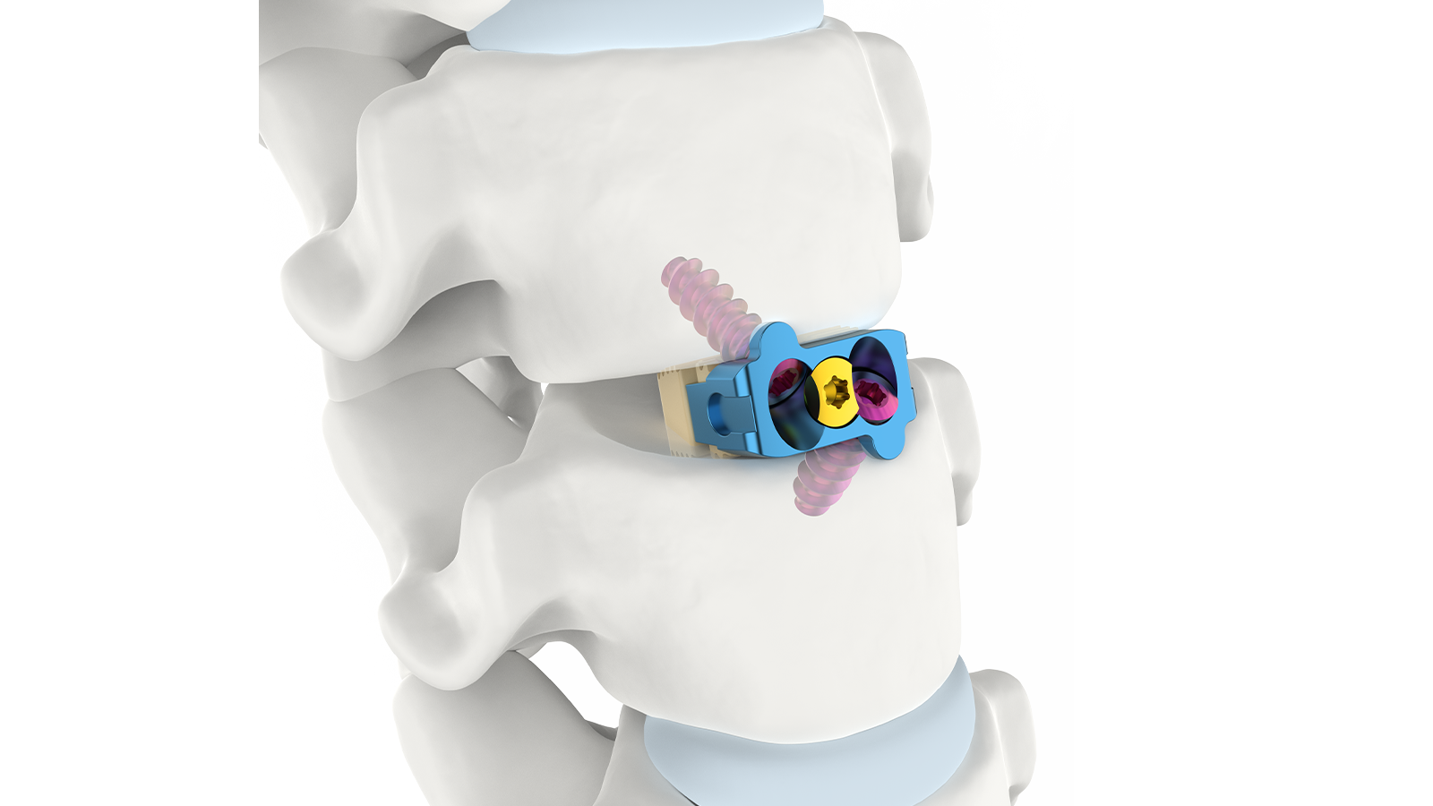 Cervical Interbody system