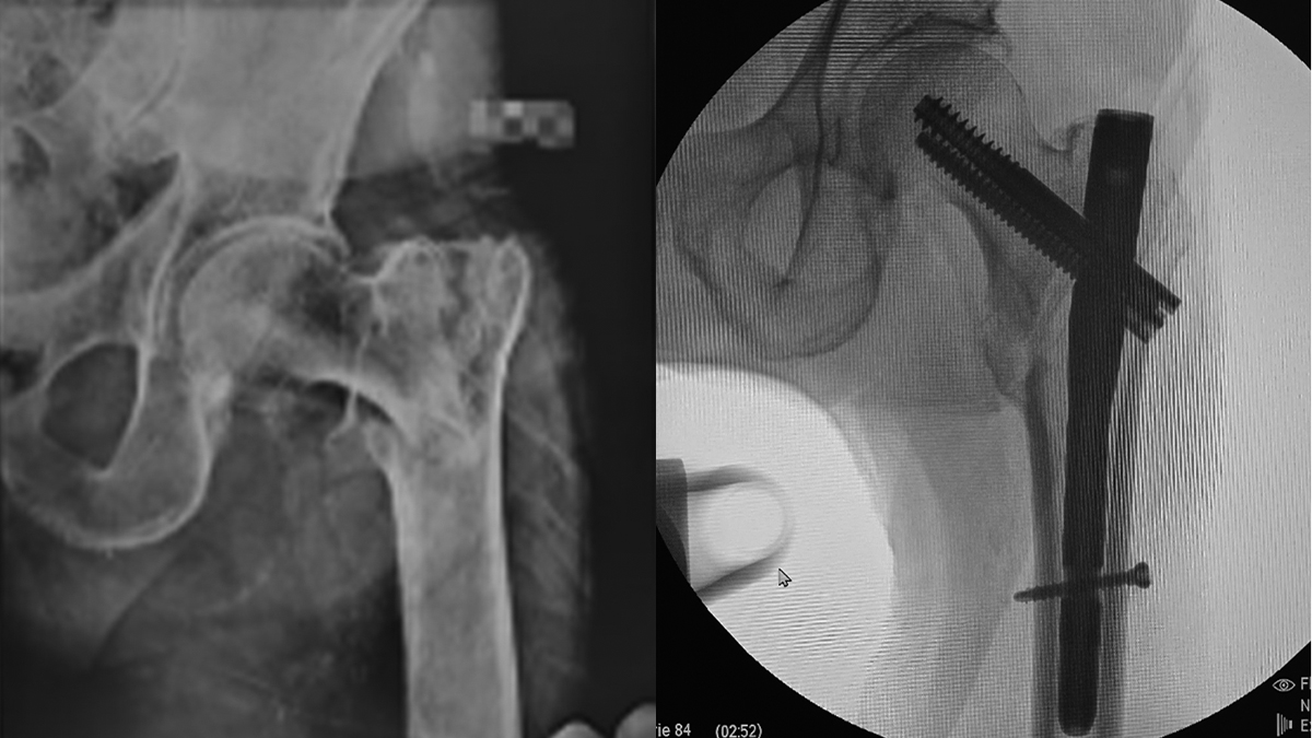 Left Intertrochanteric Fracture Treated with Intertan Intramedullary Nail in Peru — clinical case cover