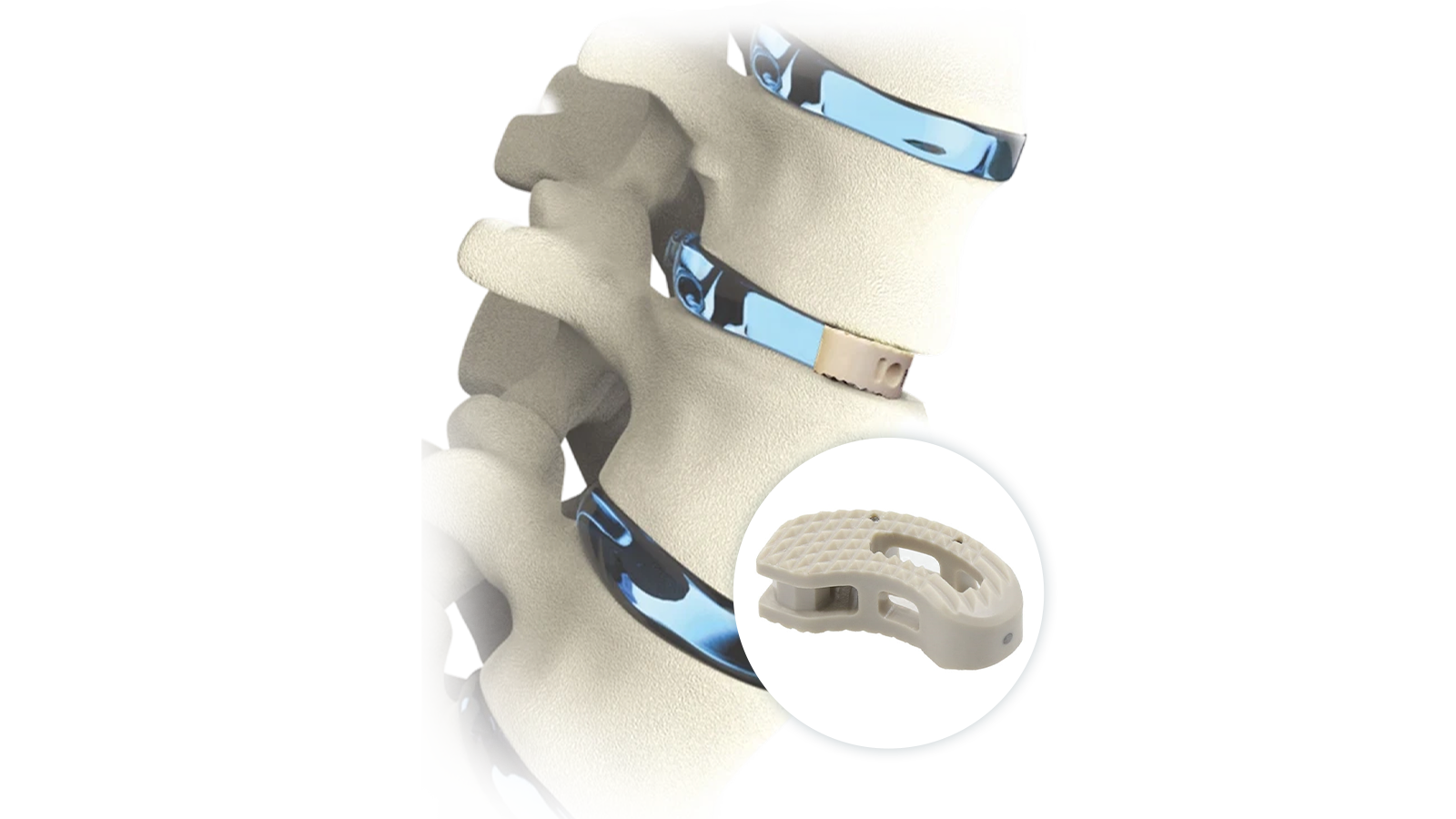 Lumbar Interbody system