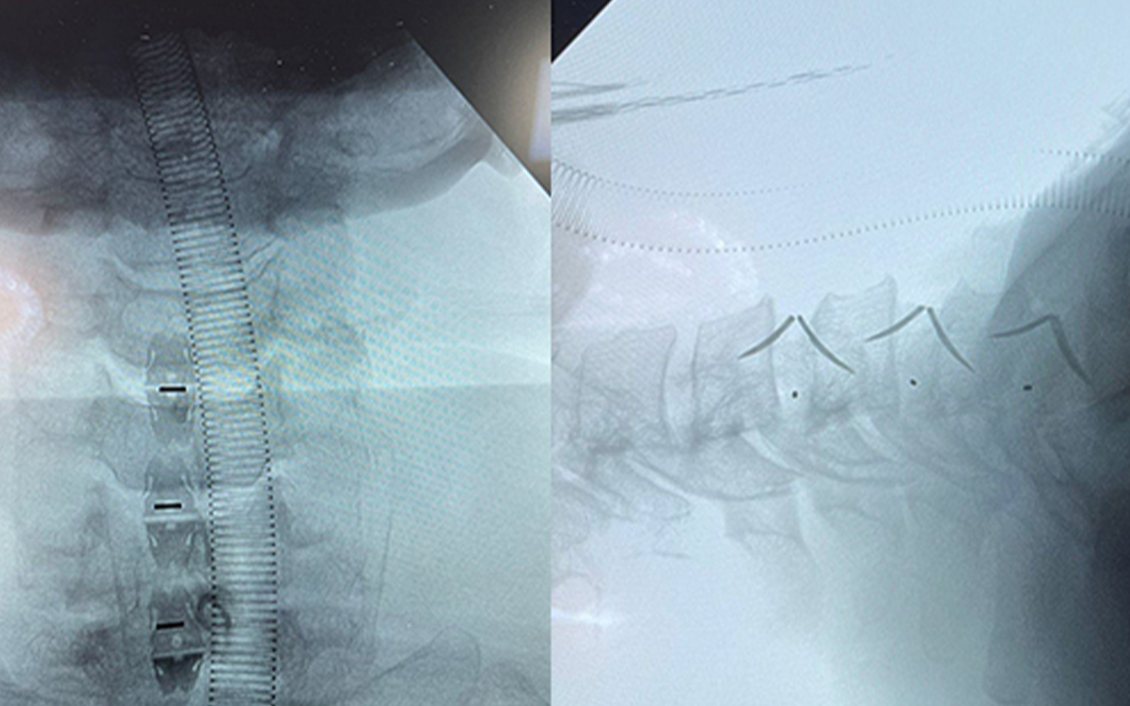 Advanced cervical fusion surgery in Mexico using Uni-C standalone cage