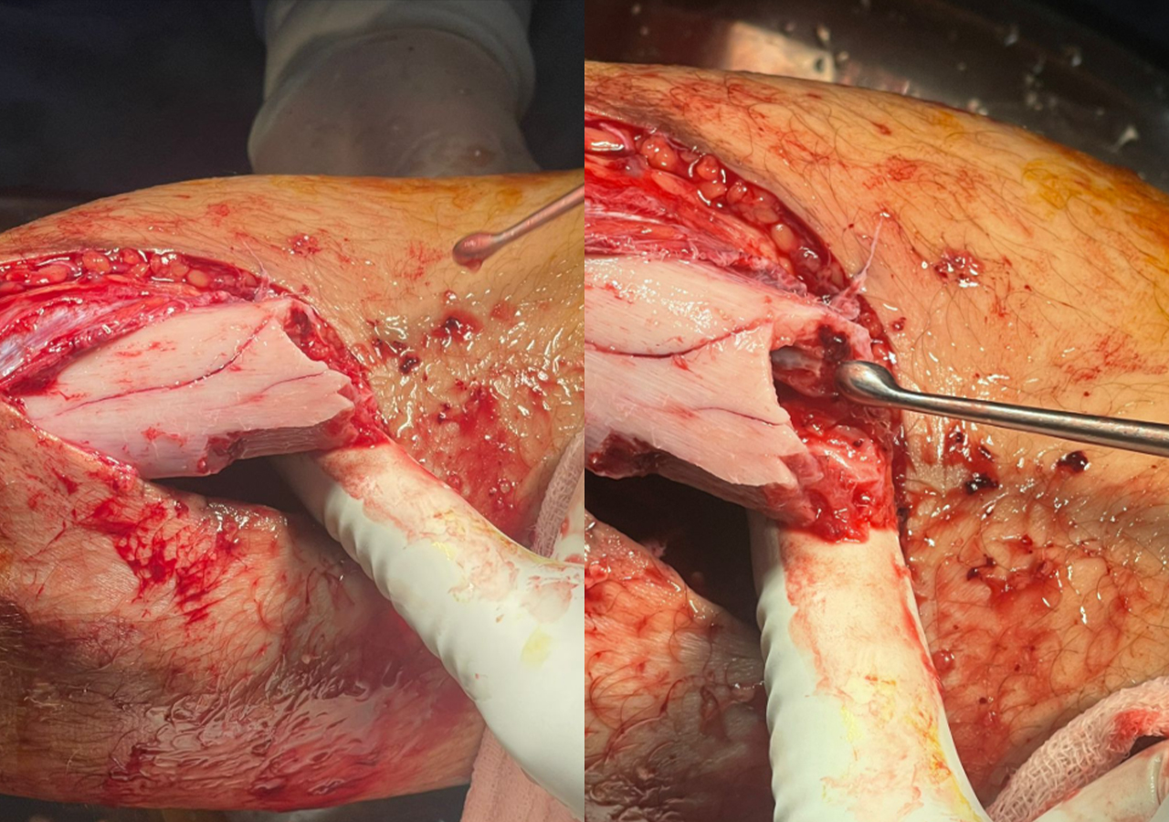 Intraoperative photographs showing tibial fracture reduction and implant placement