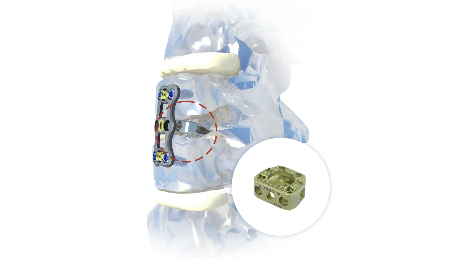 FUSA-CA™ Titaan servikale tussenliggaamstelsel