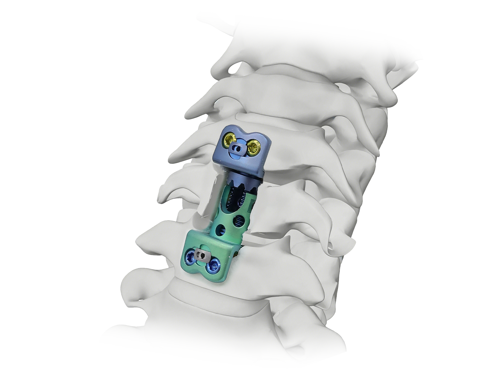 Vertebral Body Replacement system