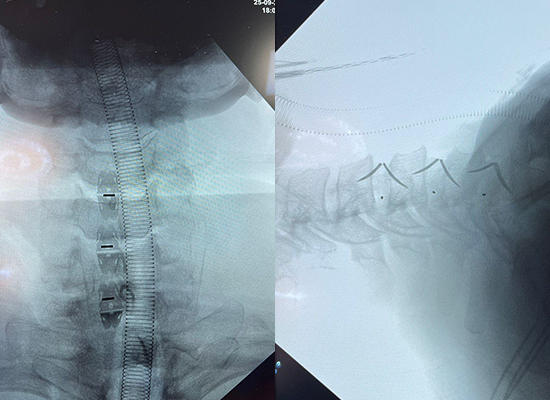 Mexican Uni-C Standalone Cervical Cage (Sterilize)