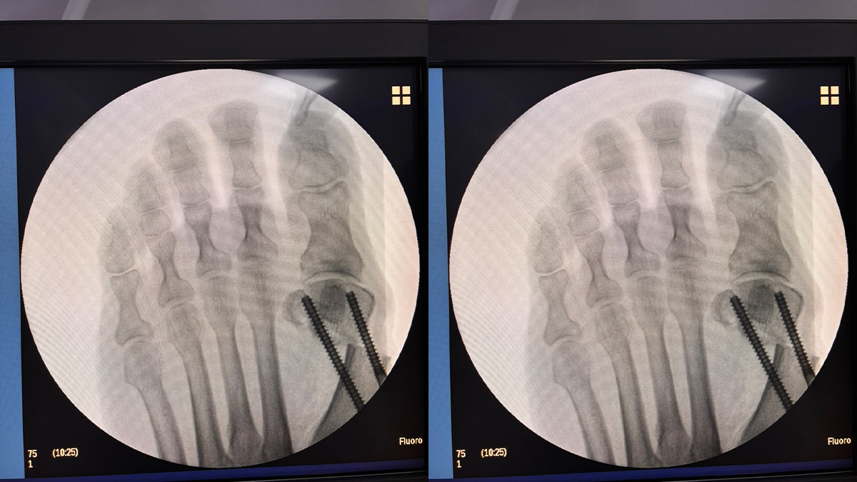 Forefoot X-ray views showing screw fixation for hallux valgus correction