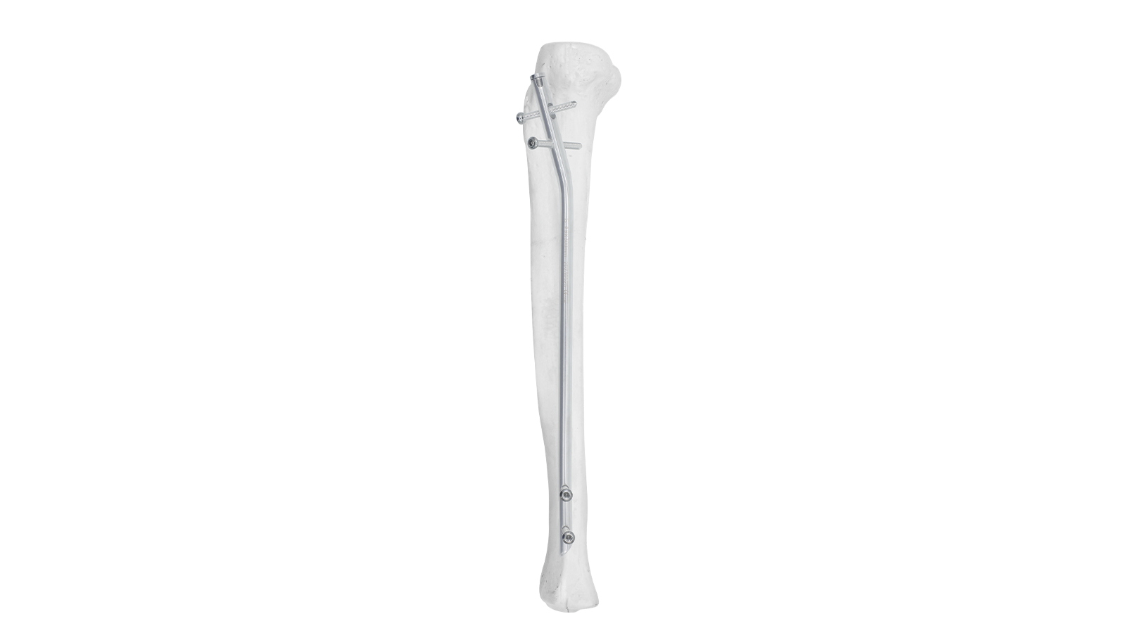 ARVO™ Tibial Intramedullary Nail