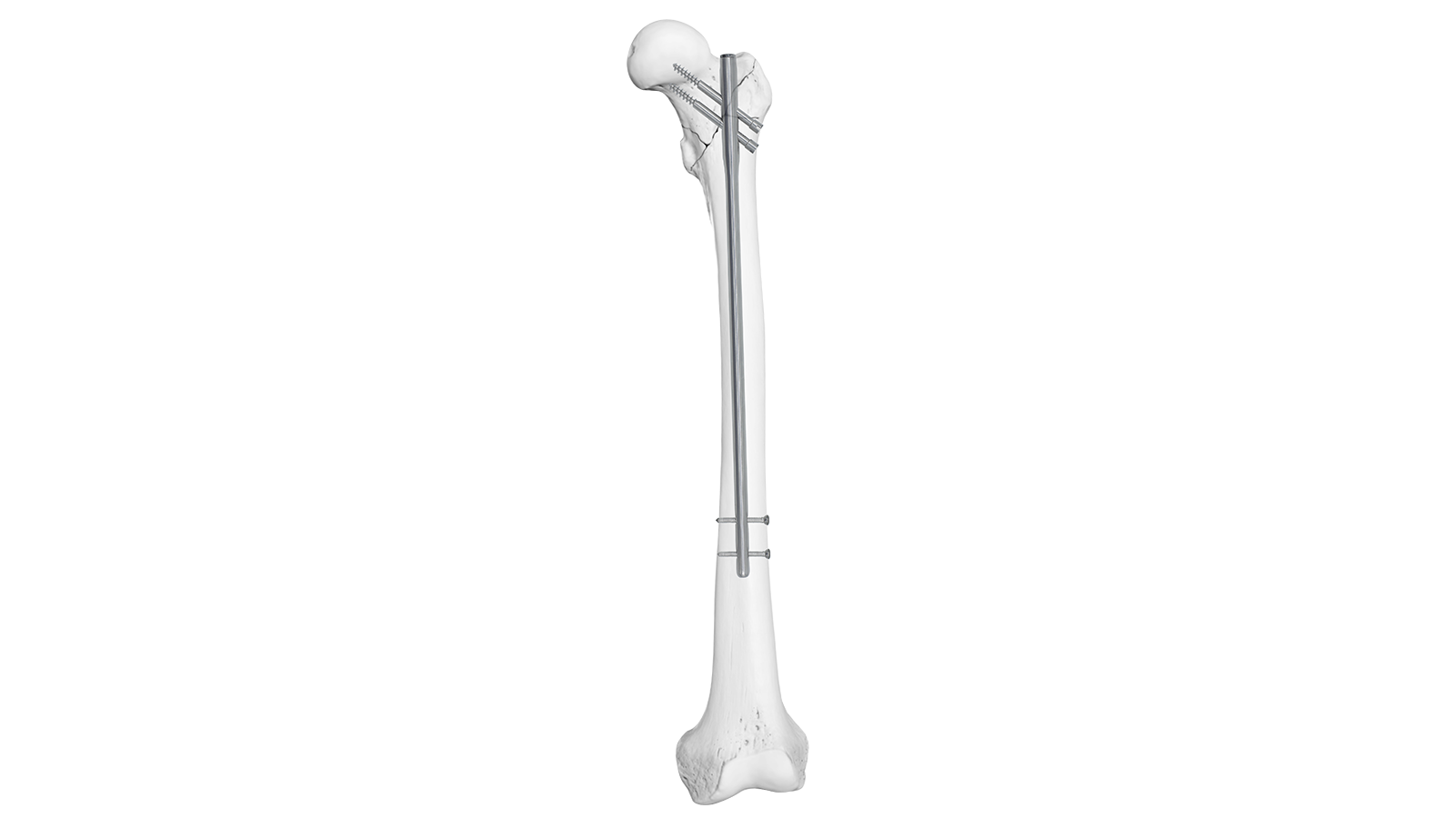 ARVO™ Femoral Reconstruction Intramedullary Nail