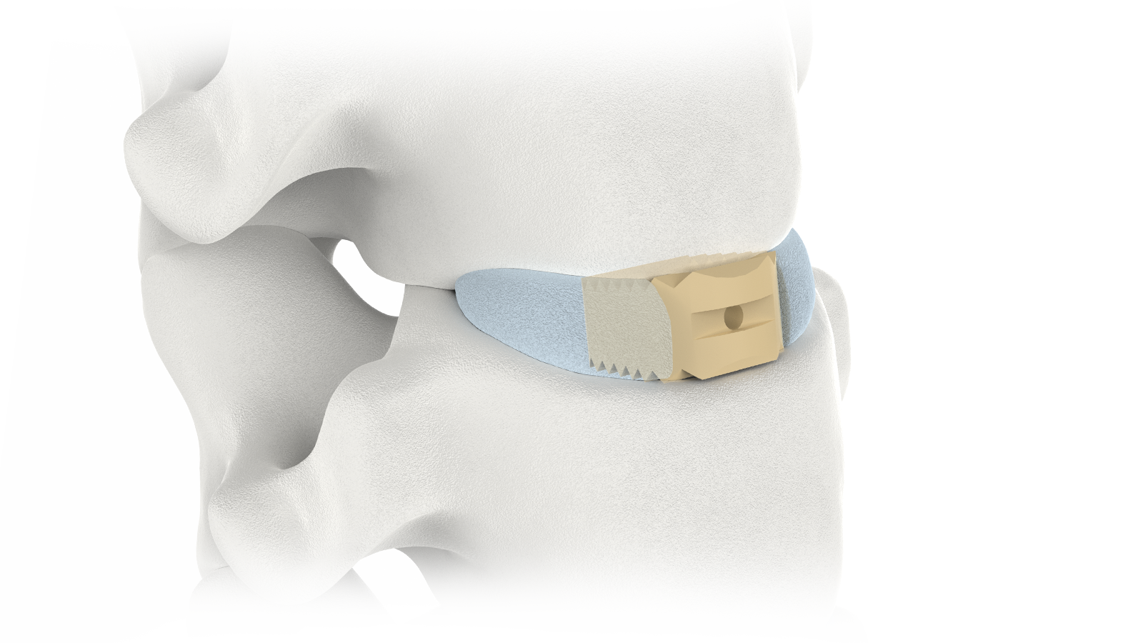 FUSA-I™ Servikale PEEK-tussenliggaamstelsel