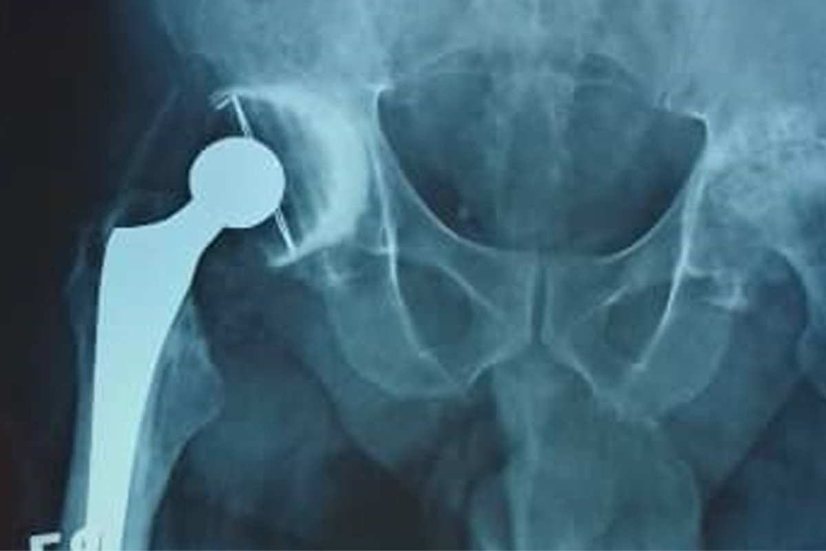 Immediate postoperative radiograph with right cemented hip prosthesis