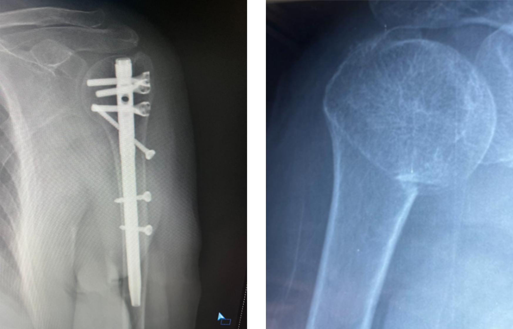 humerus intramedullary nagel fixaasje ortopedyske sjirurgy.jpg