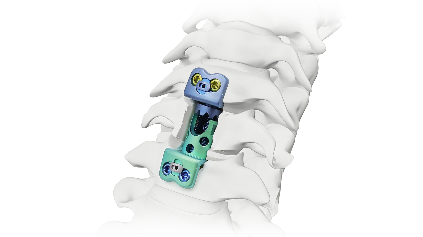 VERTA-CX™ Cervical Expandable VBR System