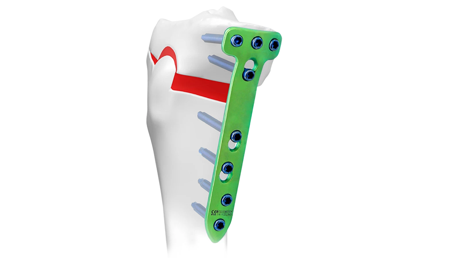 Osteotomy locking plate system