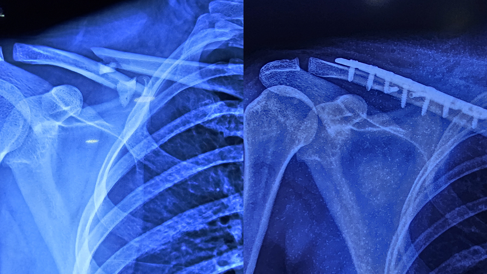 Successful Clavicle Fracture Treatment with S-Clavicle Locking Plate