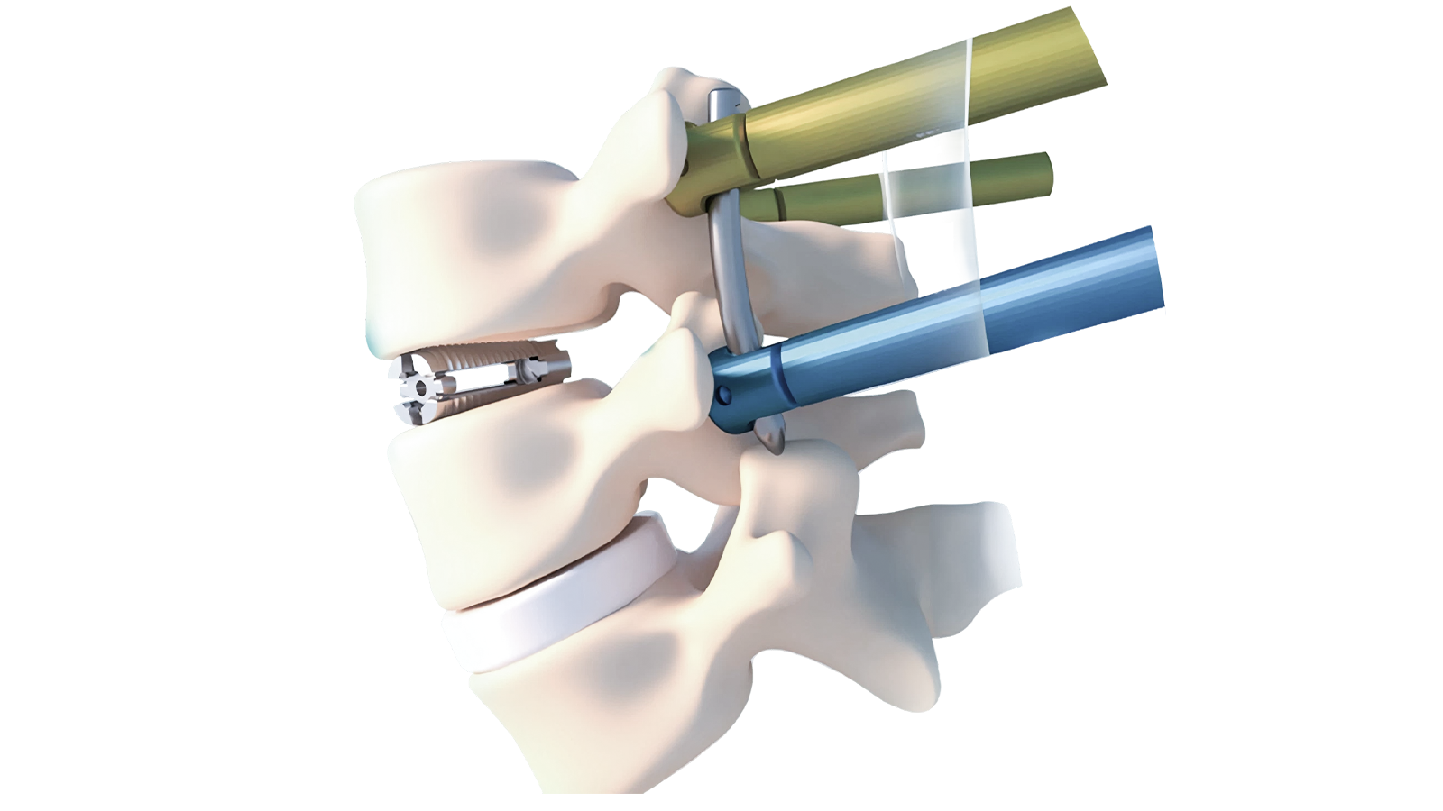 FUSA-LF™ Lateral Titanium Lumbar Interbody System