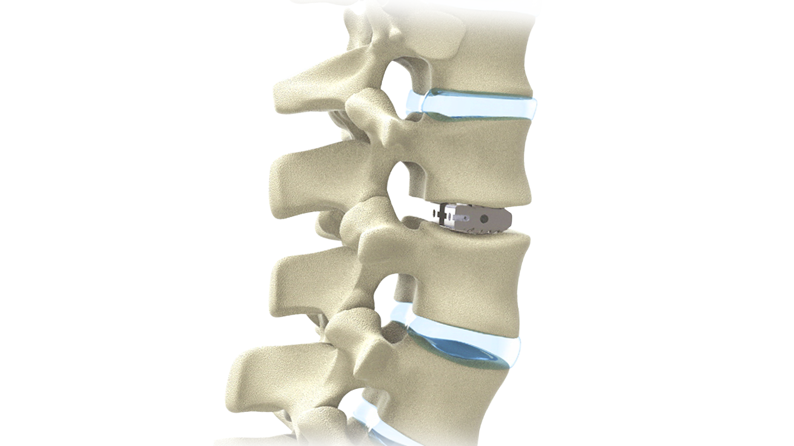 FUSA-PL™ PLIF PEEK Interbody System