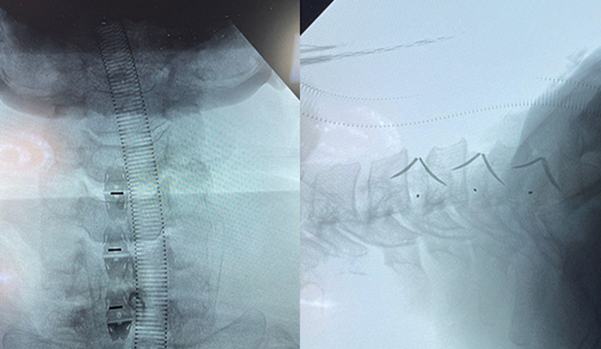 Edistynyt kohdunkaulan fuusiokirurgia Meksikossa Uni-C:n erillish&auml;kin avulla | CZMEDITECH Spine Technology