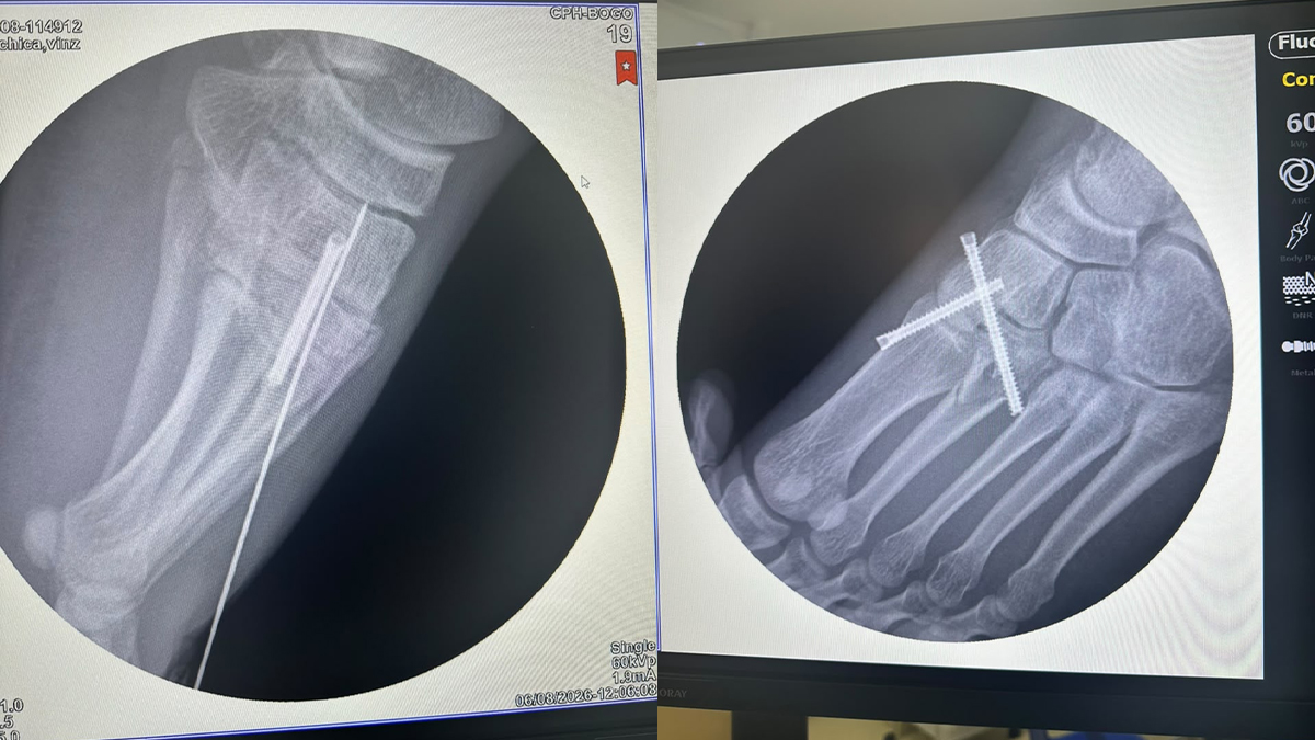 Foot X-ray views showing Herbert screw fixation